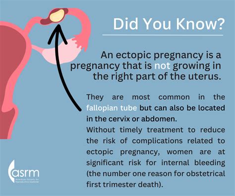Can you have an ectopic pregnancy without knowing.